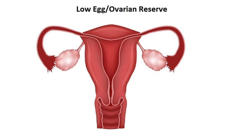 Poor ovarian reserve